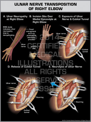 Ulnar Nerve Transposition of Right Elbow Ulnar Nerve Transposition of Right Elbow