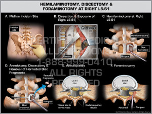 Exhibit of Hemilaminotomy, Discectomy & Foraminotomy at Right L5-S1 Exhibit of Hemilaminotomy, Discectomy & Foraminotomy at Right L5-S1