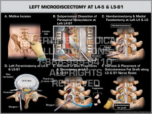 Exhibit of Left Microdiscectomy at L4-5 & L5-S1 - Print Quality Instant Download Exhibit of Left Microdiscectomy at L4-5 & L5-S1 - Print Quality Instant Download