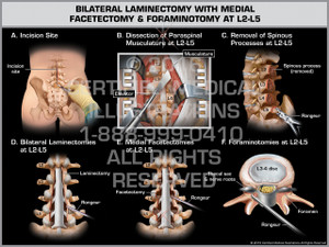 Exhibit of Bilateral Laminectomy with Medial Facetectomy & Foraminotomy at L2-L5 - Print Quality Instant Download Exhibit of Bilateral Laminectomy with Medial Facetectomy & Foraminotomy at L2-L5 - Print Quality Instant Download