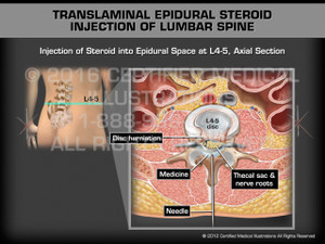 Animation of Translaminal Epidural Steroid Injection of Lumbar Spine - Medical Animation (Male)