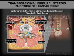 Animation of Transforaminal Epidural Steroid Injection of Lumbar Spine - Medical Animation (Female)