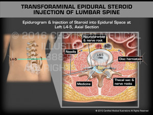 Animation of Transforaminal Epidural Steroid Injection of Lumbar Spine - Medical Animation (male)