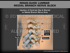 Animation of Image-Guide Lumbar Medial Branch Nerve Block - Medical Animation Animation of Image-Guide Lumbar Medial Branch Nerve Block - Medical Animation