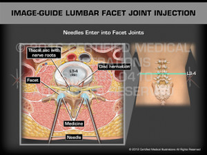 Animation of Image-Guide Lumbar Facet Joint Injection - Medical Animation Animation of Image-Guide Lumbar Facet Joint Injection - Medical Animation