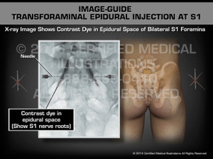 Animation of Image-Guide Transforaminal Epidural Injection at S1 - Medical Animation Animation of Image-Guide Transforaminal Epidural Injection at S1 - Medical Animation
