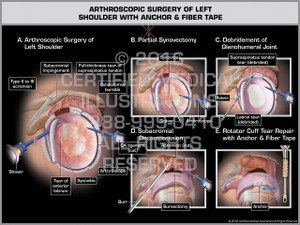 Exhibit of Arthroscopic Surgery of Left Shoulder with Anchor & Fiber Tape - Print Quality Instant Download Exhibit of Arthroscopic Surgery of Left Shoulder with Anchor & Fiber Tape - Print Quality Instant Download