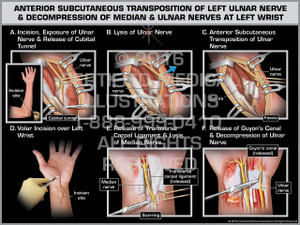 Exhibit of Anterior Subcutaneous Transposition of Left Ulnar Nerve & Decompression of Median & Ulnar Nerves at Left Wrist