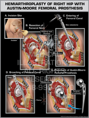 Exhibit of Hemiarthroplasty of Right Hip with Austin-Moore Femoral Prosthesis