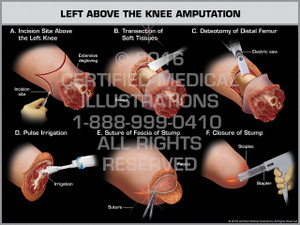 Exhibit of Left Above the Knee Amputation - Print Quality Instant Download Exhibit of Left Above the Knee Amputation - Print Quality Instant Download