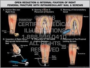 Exhibit of Open Reduction & Internal Fixation of Right Femoral Fracture with Intramedullary Nail & Screws