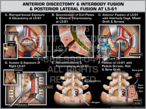 Exhibit of Anterior Discectomy & Interbody Fusion & Posterior Lateral Fusion at L5-S1 Exhibit of Anterior Discectomy & Interbody Fusion & Posterior Lateral Fusion at L5-S1