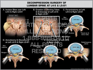 Exhibit of Decompression Surgery of Lumbar Spine at L4-5 & L5-S1 Exhibit of Decompression Surgery of Lumbar Spine at L4-5 & L5-S1