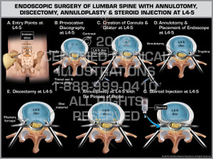 Exhibit of Endoscopic Surgery of Lumbar Spine with Annulotomy, Discectomy, Annuloplasty & Steroid Injection at L4-5 Exhibit of Endoscopic Surgery of Lumbar Spine with Annulotomy, Discectomy, Annuloplasty & Steroid Injection at L4-5