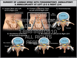 Exhibit of Surgery of Lumbar Spine with Foraminotomy, Annulotomy & Annuloplasty at Left L2-3 & Right L3-4 - Print Quality Instant Download Exhibit of Surgery of Lumbar Spine with Foraminotomy, Annulotomy & Annuloplasty at Left L2-3 & Right L3-4 - Print Quality Instant Download