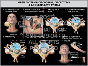 Exhibit of Open Anterior Discogram, Discectomy & Annuloplasty at C3-4 - Print Quality Instant Download Exhibit of Open Anterior Discogram, Discectomy & Annuloplasty at C3-4 - Print Quality Instant Download