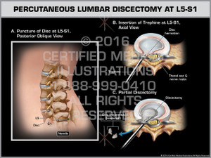 Exhibit of Percutaneous Lumbar Discectomy at L5-S1 - Print Quality Instant Download Exhibit of Percutaneous Lumbar Discectomy at L5-S1 - Print Quality Instant Download