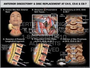 Exhibit of Anterior Discectomy & Disc Replacement at C4-5, C5-6 & C6-7 
