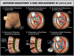 Exhibit of Anterior Discectomy & Disc Replacement at L3-4 & L4-5 Exhibit of Anterior Discectomy & Disc Replacement at L3-4 & L4-5