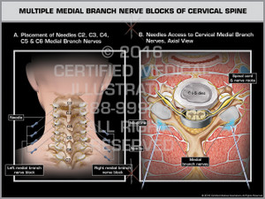 Exhibit of Multiple Medial Branch Nerve Blocks of Cervical Spine Exhibit of Multiple Medial Branch Nerve Blocks of Cervical Spine