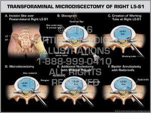 Exhibit of Transforaminal Microdiscectomy of Right L5-S1 - Print Quality Instant Download Exhibit of Transforaminal Microdiscectomy of Right L5-S1 - Print Quality Instant Download