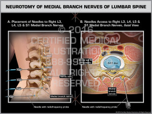 Exhibit of Neurotomy of Medial Branch Nerves of Lumbar Spine Exhibit of Neurotomy of Medial Branch Nerves of Lumbar Spine