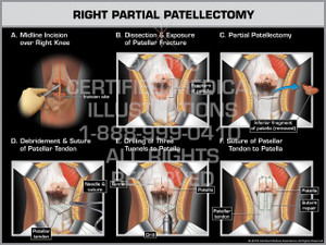 Exhibit of Right Partial Patellectomy - Print Quality Instant Download