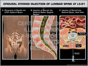 Exhibit of Epidural Steroid Injection of Lumbar Spine at L5-S1 - Print Quality Instant Download Exhibit of Epidural Steroid Injection of Lumbar Spine at L5-S1 - Print Quality Instant Download
