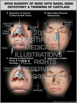 Exhibit of Open Surgery of Nose with Nasal Bone Osteotomy & Trimming of Cartilage Exhibit of Open Surgery of Nose with Nasal Bone Osteotomy & Trimming of Cartilage