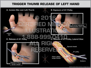 Exhibit of Trigger Thumb Release of Left Hand Exhibit of Trigger Thumb Release of Left Hand