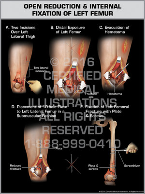 Exhibit of Open Reduction & Internal Fixation of Left Femur - Print Quality Instant Download