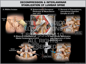 Exhibit of Decompression & Interlaminar Stabilization of Lumbar Spine - Print Quality Instant Download