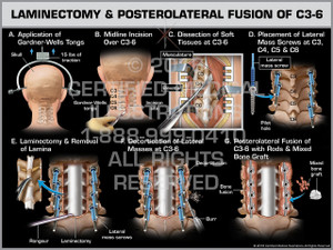 Exhibit of Laminectomy & Posterolateral Fusion of C3-6
