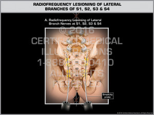 Exhibit of Radiofrequency Lesioning of Lateral Branches of S1, S2, S3 & S4 Exhibit of Radiofrequency Lesioning of Lateral Branches of S1, S2, S3 & S4
