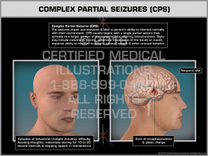 Exhibit of Complex Partial Seizures (CPS) - Print Quality Instant Download