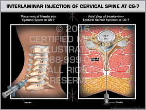 Exhibit of Interlaminar Injection of Cervical Spine at C6-7 - Print Quality Instant Download Exhibit of Interlaminar Injection of Cervical Spine at C6-7 - Print Quality Instant Download