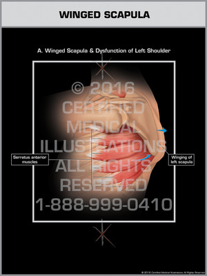 Exhibit of Winged Scapula - Print Quality Instant Download Exhibit of Winged Scapula - Print Quality Instant Download