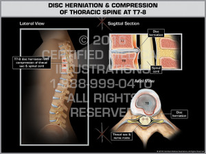 Exhibit of Disc Herniation & Compression of Thoracic Spine at T7-8 - Print Quality Instant Download Exhibit of Disc Herniation & Compression of Thoracic Spine at T7-8 - Print Quality Instant Download