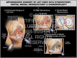 Exhibit of Arthroscopic Surgery of Left Knee with Synovectomy, Partial Medial Meniscectomy & Chondroplasty - Print Quality Instant Download Exhibit of Arthroscopic Surgery of Left Knee with Synovectomy, Partial Medial Meniscectomy & Chondroplasty - Print Quality Instant Download