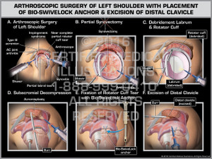Exhibit of Arthroscopic Surgery of Left Shoulder with Placement of Bio-SwiveLock Anchor & Excision of Distal Clavicle Exhibit of Arthroscopic Surgery of Left Shoulder with Placement of Bio-SwiveLock Anchor & Excision of Distal Clavicle