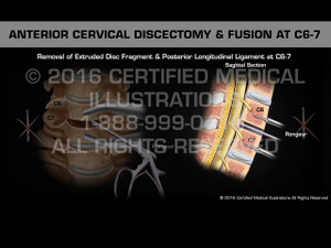 Animation of Anterior Cervical Discectomy & Fusion at C6-7 - Medical Animation Animation of Anterior Cervical Discectomy & Fusion at C6-7 - Medical Animation