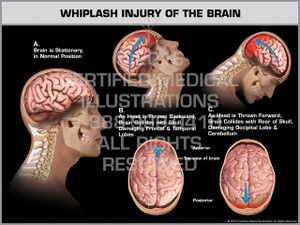 Exhibit of Whiplash Injury of the Brain Exhibit of Whiplash Injury of the Brain