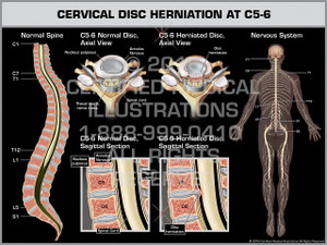 Exhibit of Cervical Disc Herniation at C5-6 - Print Quality Instant Download