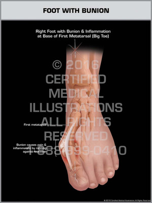 Exhibit of Foot with Bunion - Print Quality Instant Download Exhibit of Foot with Bunion - Print Quality Instant Download
