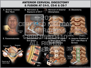 Exhibit of Anterior Cervical Discectomy & Fusion at C4-5, C5-6 & C6-7 - Print Quality Instant Download