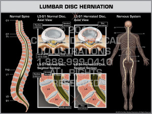 Exhibit of Lumbar Disc Herniation Exhibit of Lumbar Disc Herniation