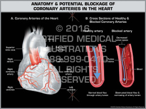 Exhibit of Anatomy & Potential Blockage of Coronary Arteries in the Heart - Print Quality Instant Download