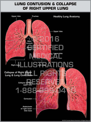 Exhibit of Lung Contusion & Collapse of Right Upper Lung Exhibit of Lung Contusion & Collapse of Right Upper Lung