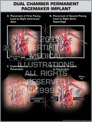 Exhibit of Dual Chamber Permanent Pacemaker Implant