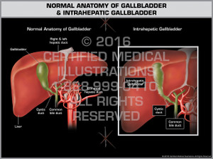 Exhibit of Normal Anatomy of Gallbladder & Intrahepatic Gallbladder Exhibit of Normal Anatomy of Gallbladder & Intrahepatic Gallbladder